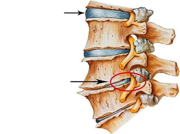 Awọn rudurudu ni awọn disiki aarin
