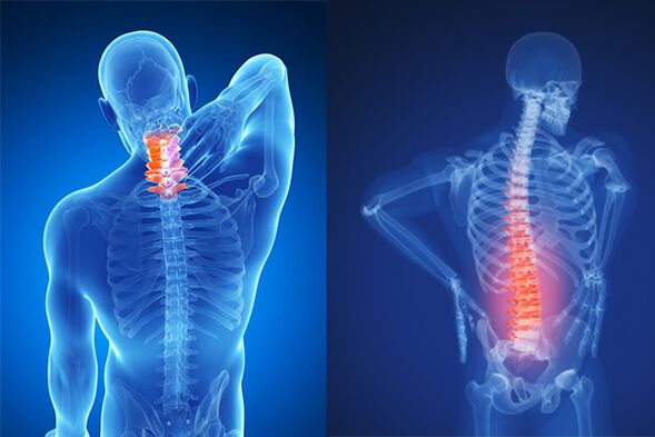 Osteochondrosis ti cervical ati lumbar ọpa ẹhin