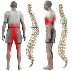 Protrusions ninu awọn ọpa ẹhin