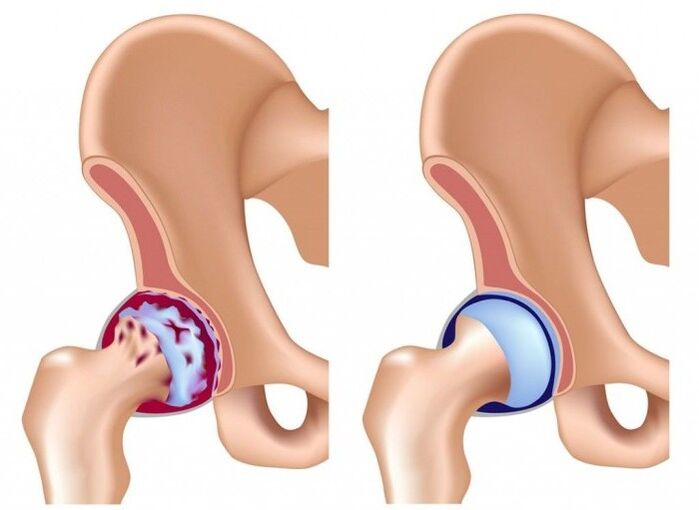 Bibajẹ si isẹpo ibadi nitori arthrosis
