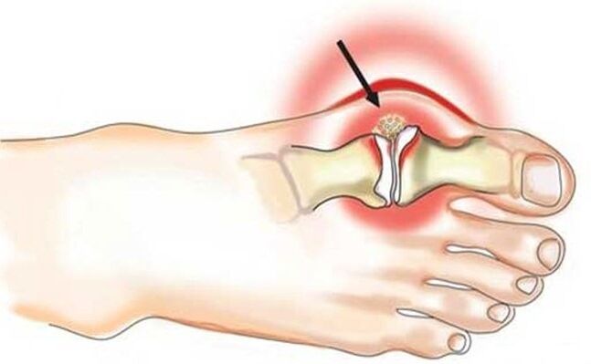 Iredodo ti isẹpo laarin atampako nla ati ẹsẹ nitori arthritis
