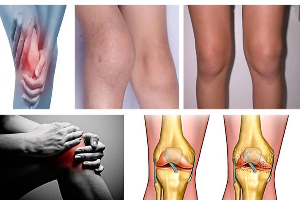 arthrosis kini o jẹ