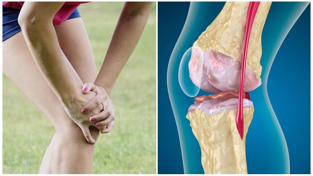 awọn aami aiṣan ti arthrosis