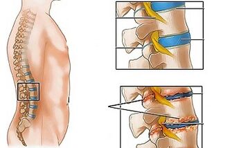 Awọn okunfa ti osteochondrosis ti Lumbar
