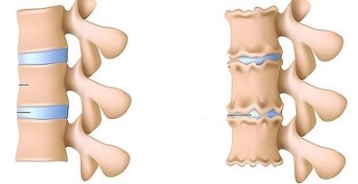 Bii o ṣe le ṣe idanimọ wiwa ti osteochondrosis ti Lumbar